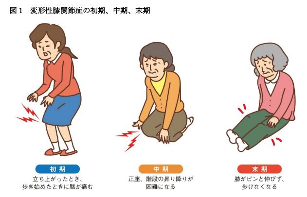 図1 変形性膝関節症の初期、中期、末期