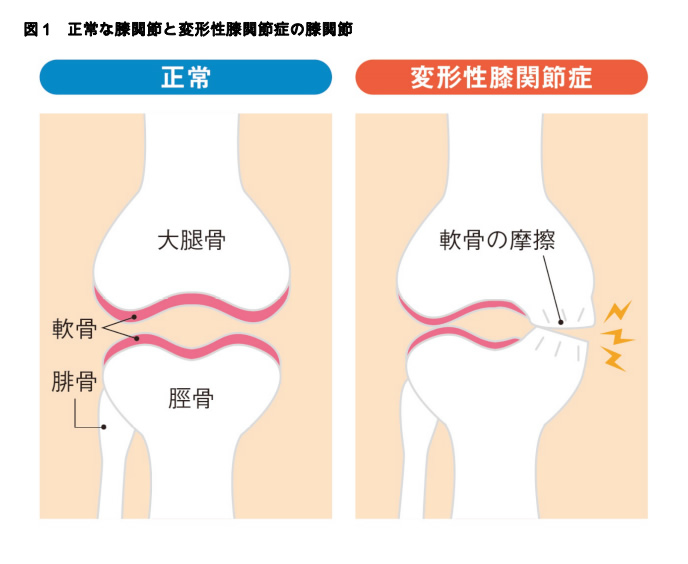 図1 正常な膝関節と変形性膝関節症の膝関節