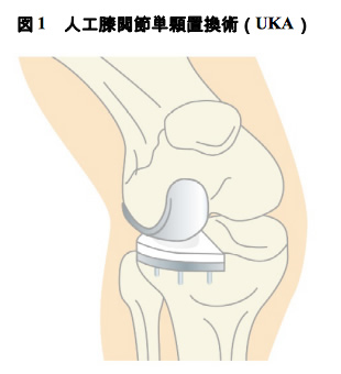 図1 人工膝関節単顆置換術