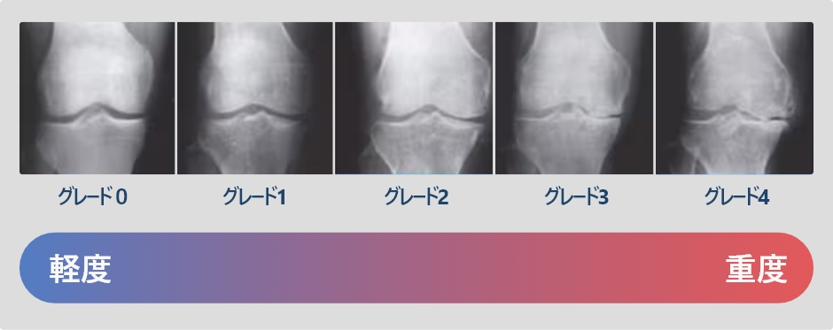 変形性膝関節症のグレードと治療法 軽度　重度