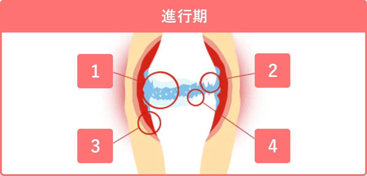 進行期