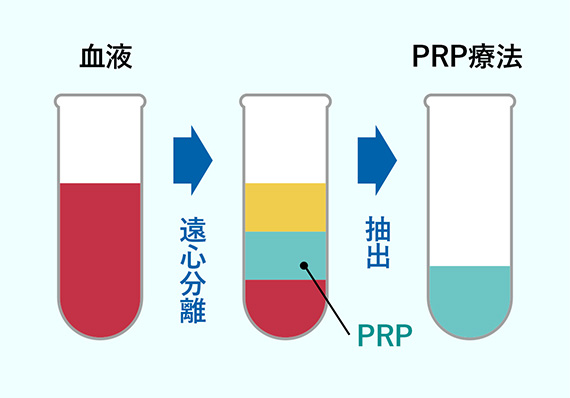 血液からPRPを抽出