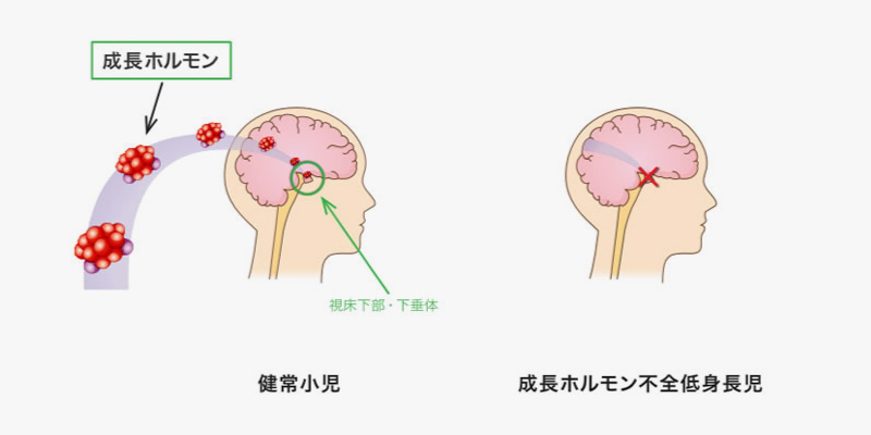成長ホルモン分泌不全