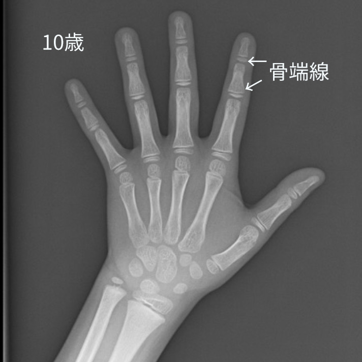 骨端線が見えるレントゲン