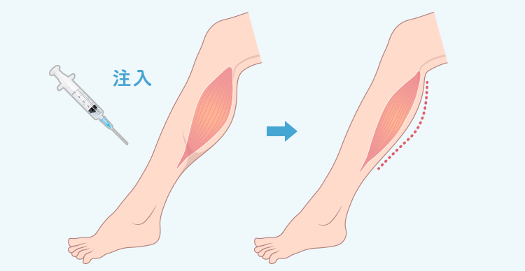 ふくらはぎボトックスとは