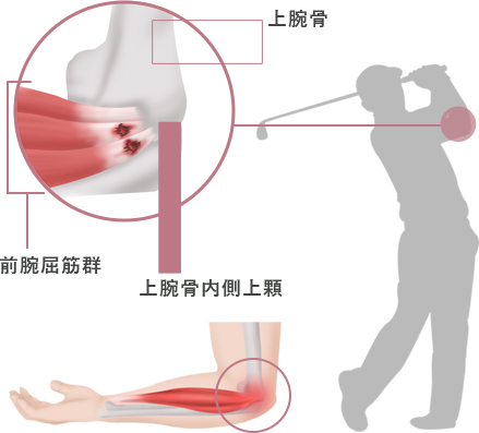 ゴルフ肘（上腕骨内側上顆炎）