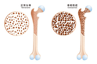 骨粗鬆症(骨粗しょう症)の治療