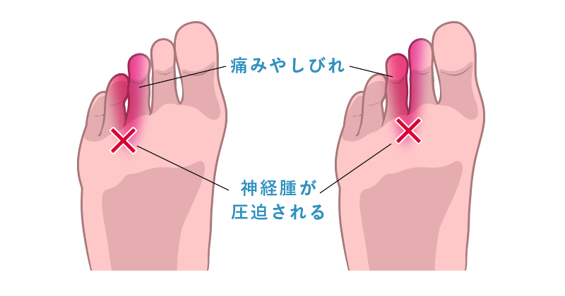モートン病