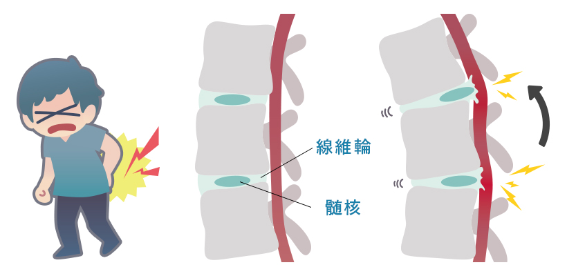 ぎっくり腰の主な症状と治療方法について