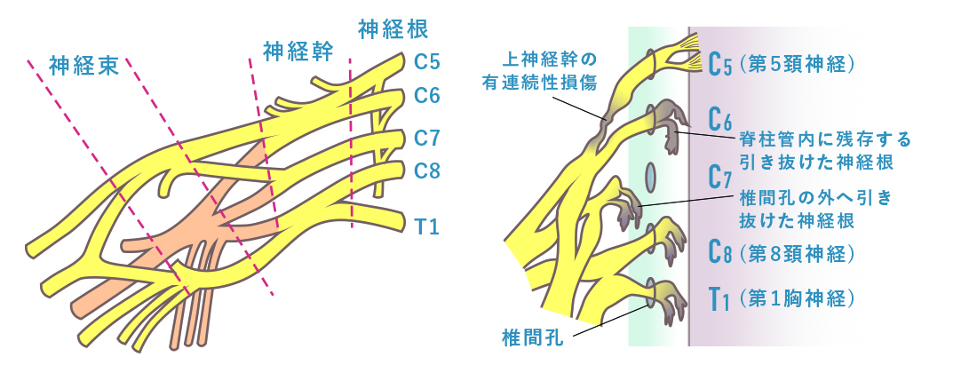 腕神経叢損傷