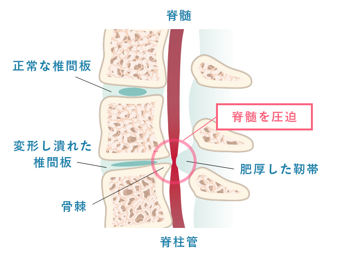 頚椎症性脊髄症
