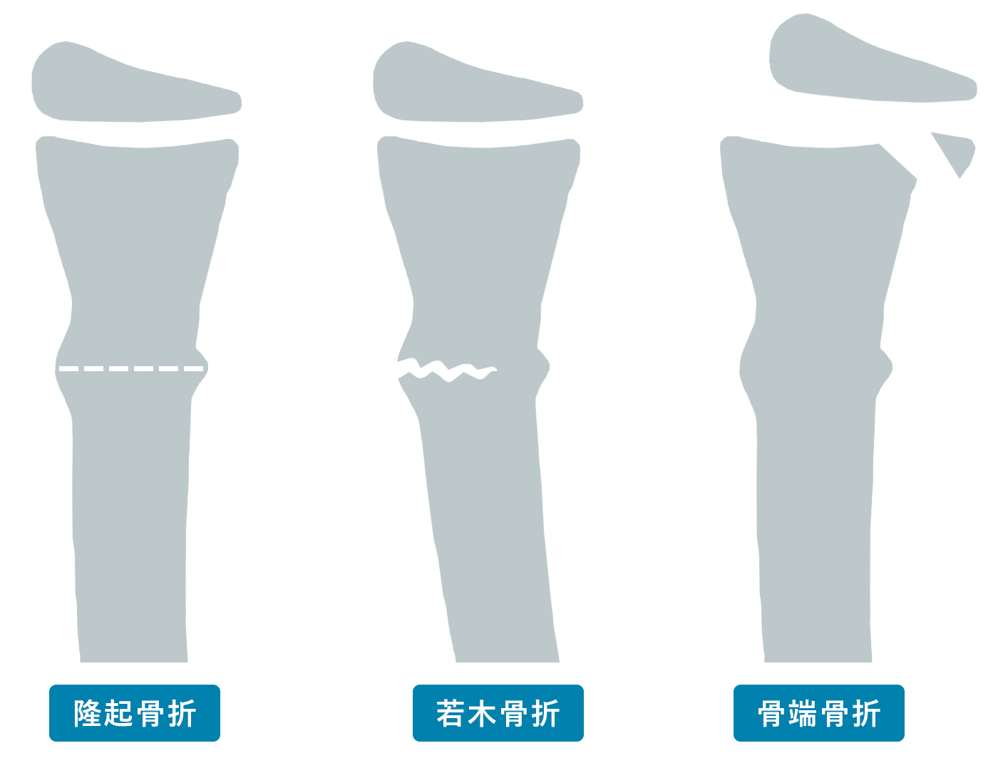 小児の骨折