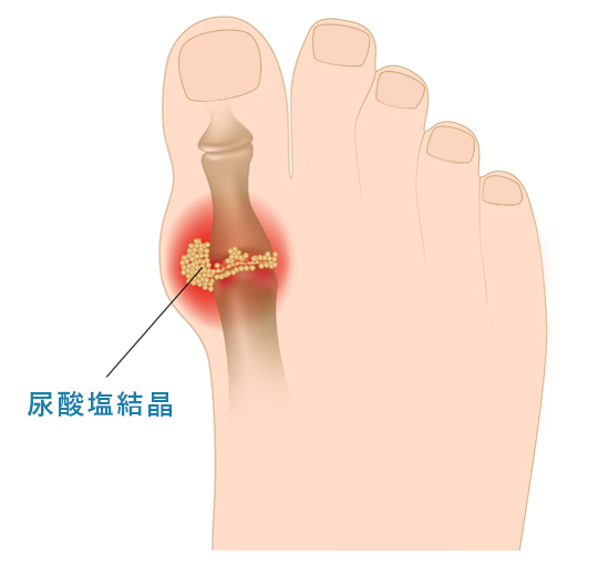 痛風