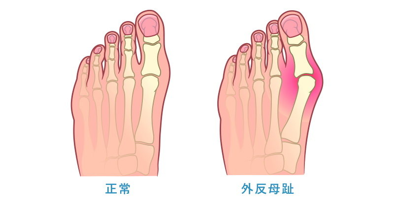 外反母趾