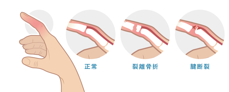 突き指の原因と治療・対処法