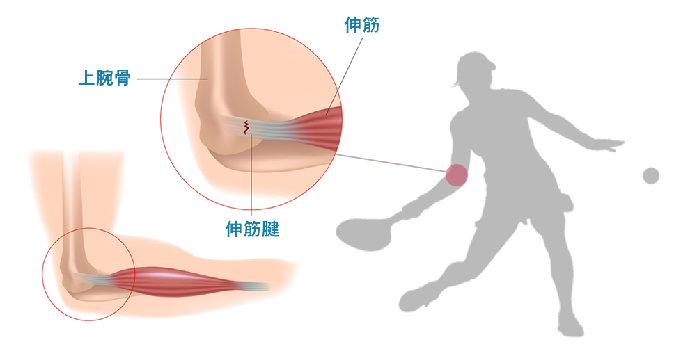テニス肘（上腕骨外側上顆炎）の原因と治療・対処法