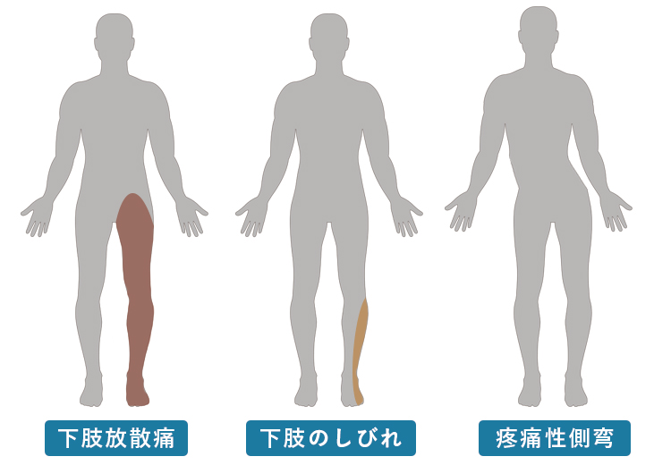 腰椎椎間板ヘルニアの主な症状と治療方法について