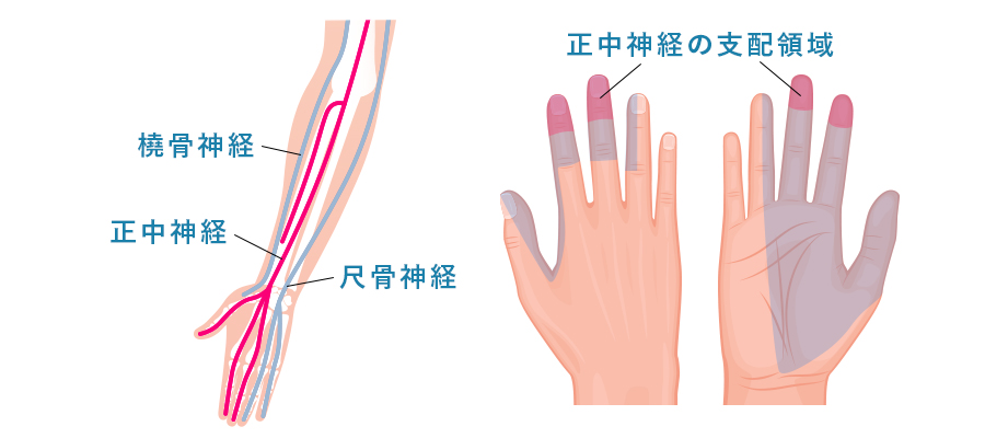 正中神経麻痺