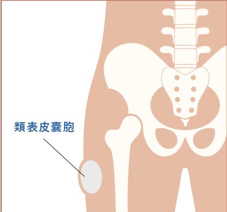 軟部腫瘍