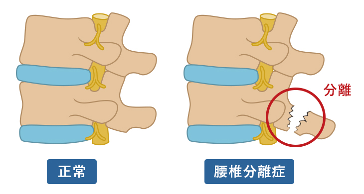 腰椎分離症の主な症状や治療方法について