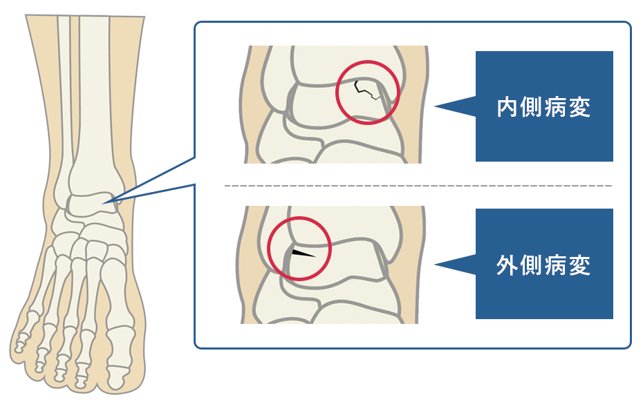 距骨骨軟骨損傷