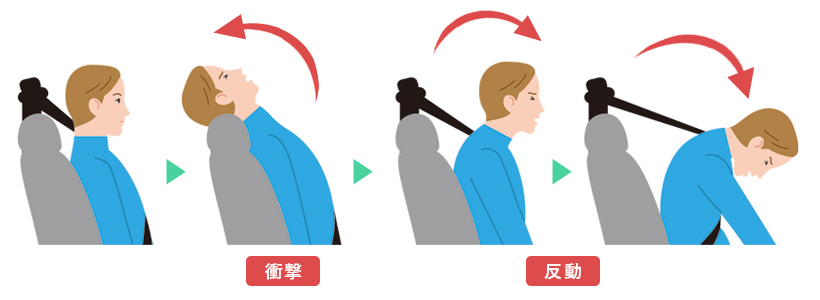 むち打ち症の原因と治療・対処法