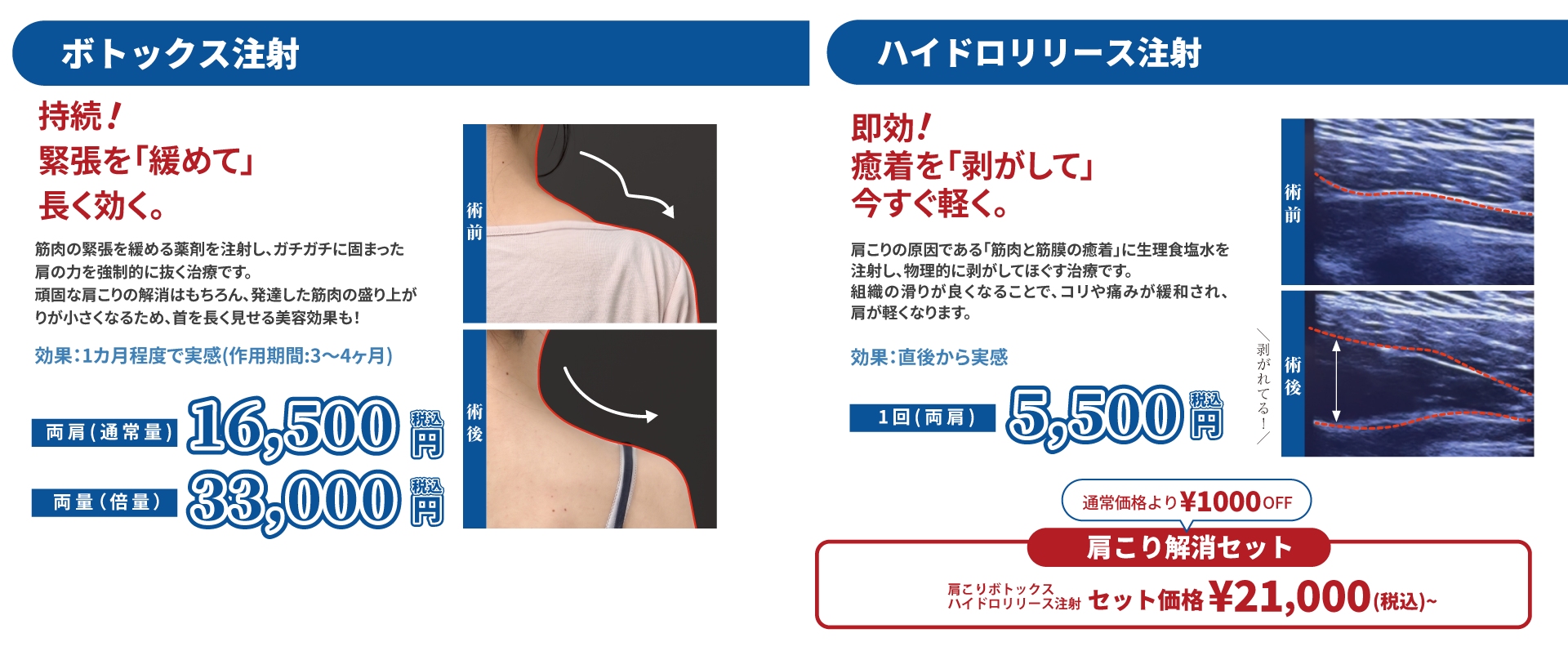 肩ボトックスとハイドロリリース注射の価格