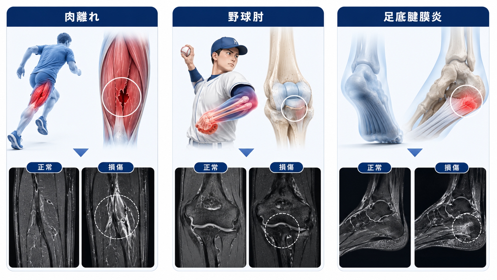 スポーツ外傷におけるエコー検査と診断