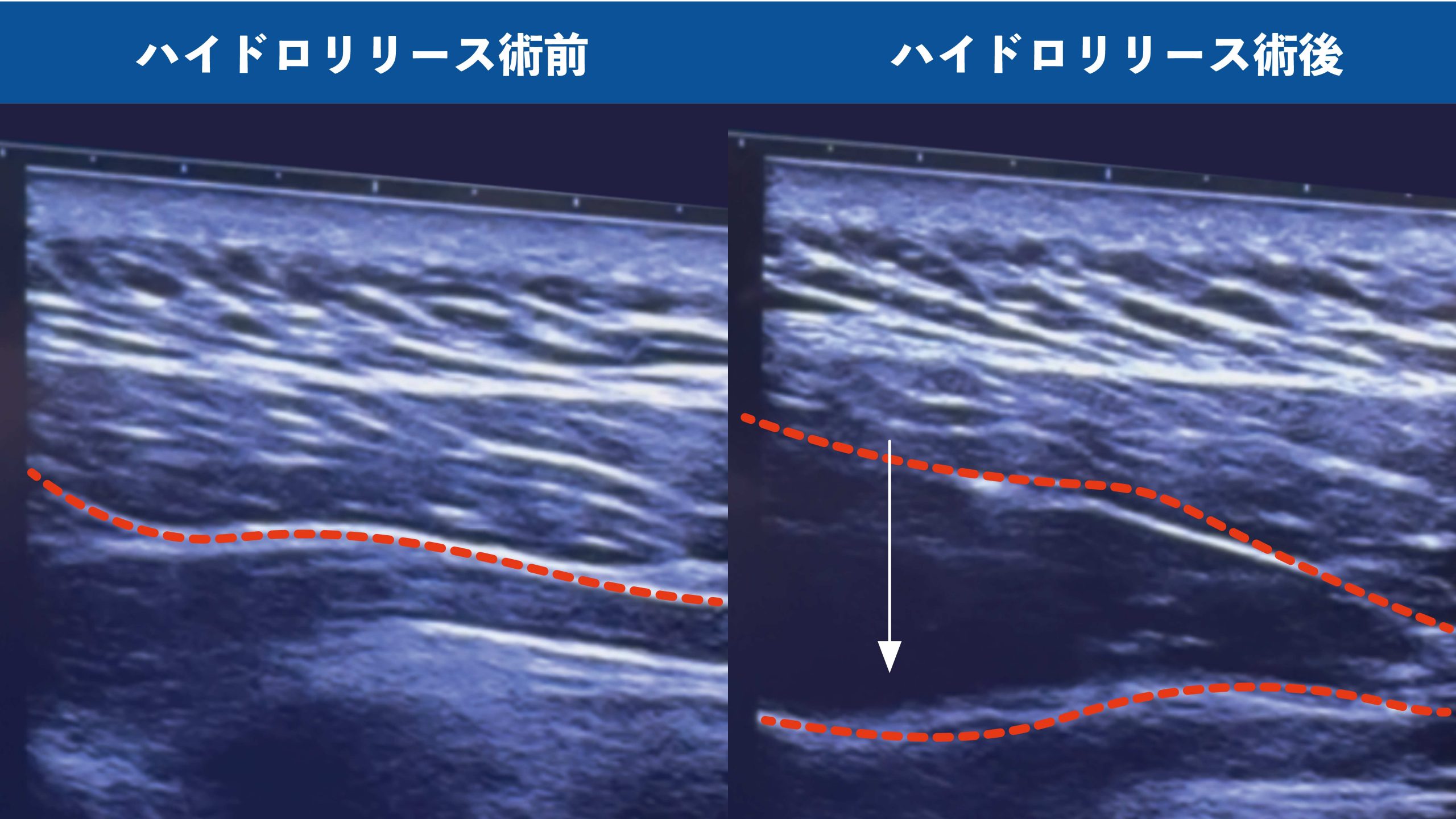 エコー下で行うハイドロリリース（筋膜リリース）の様子