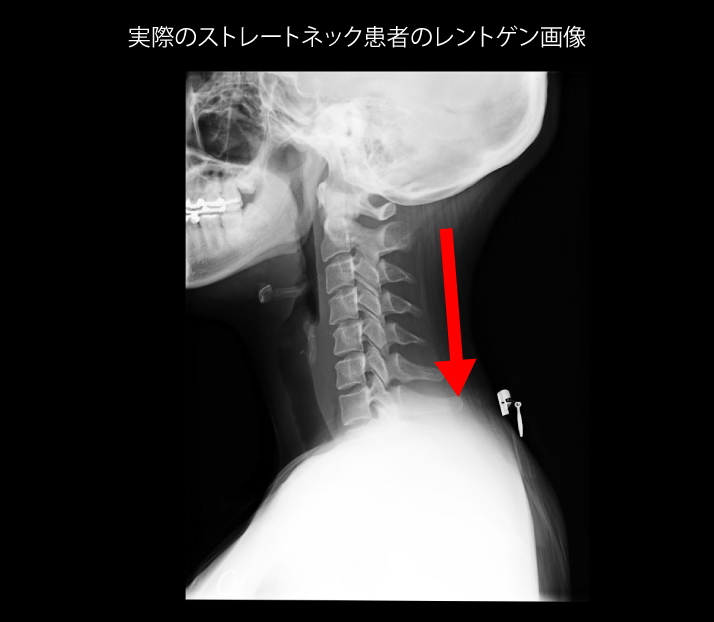 実際のストレートネック患者の頚椎レントゲン画像（側面像）