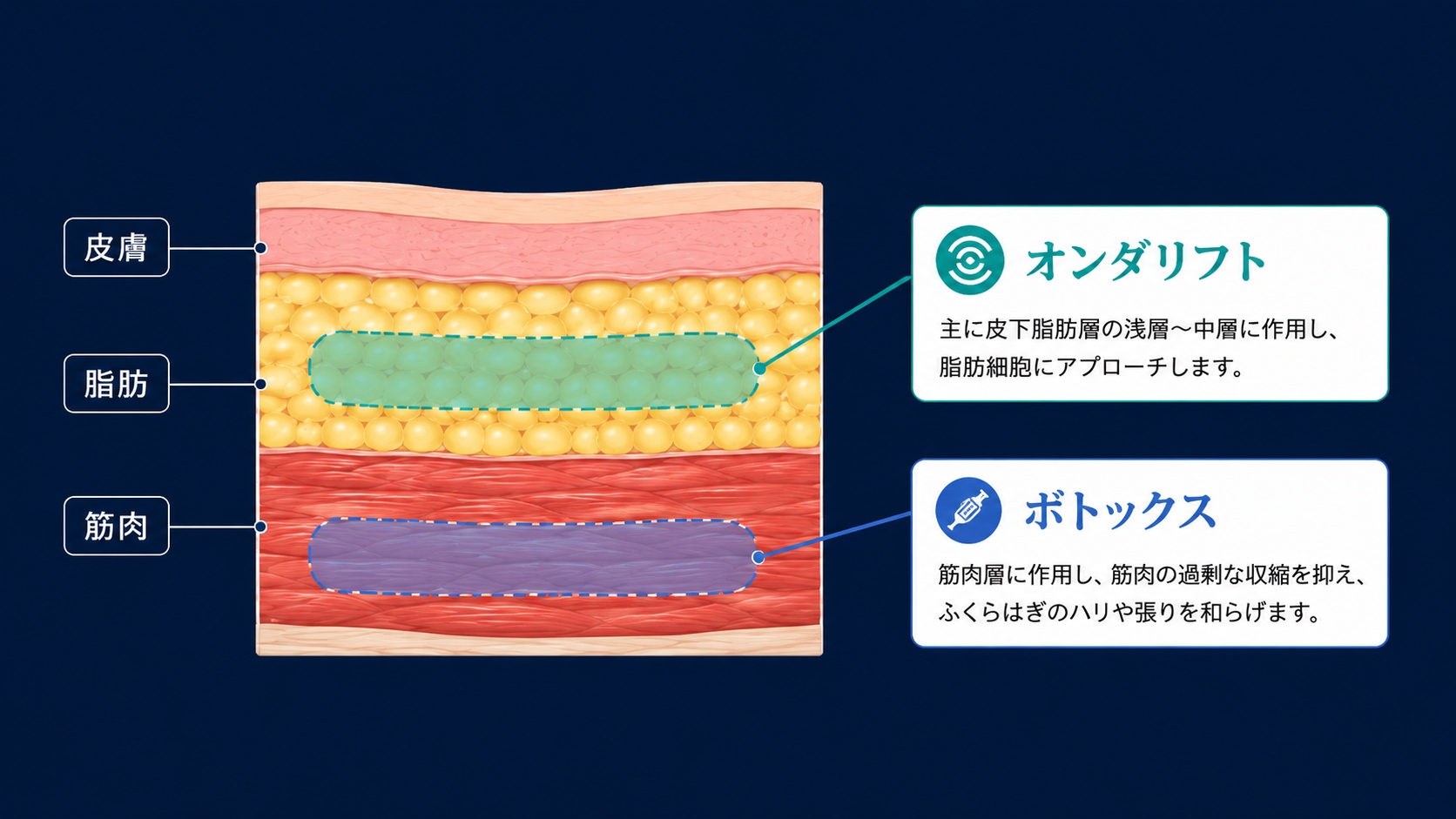 オンダリフトとふくらはぎボトックスが作用する範囲の違いを示す断面図