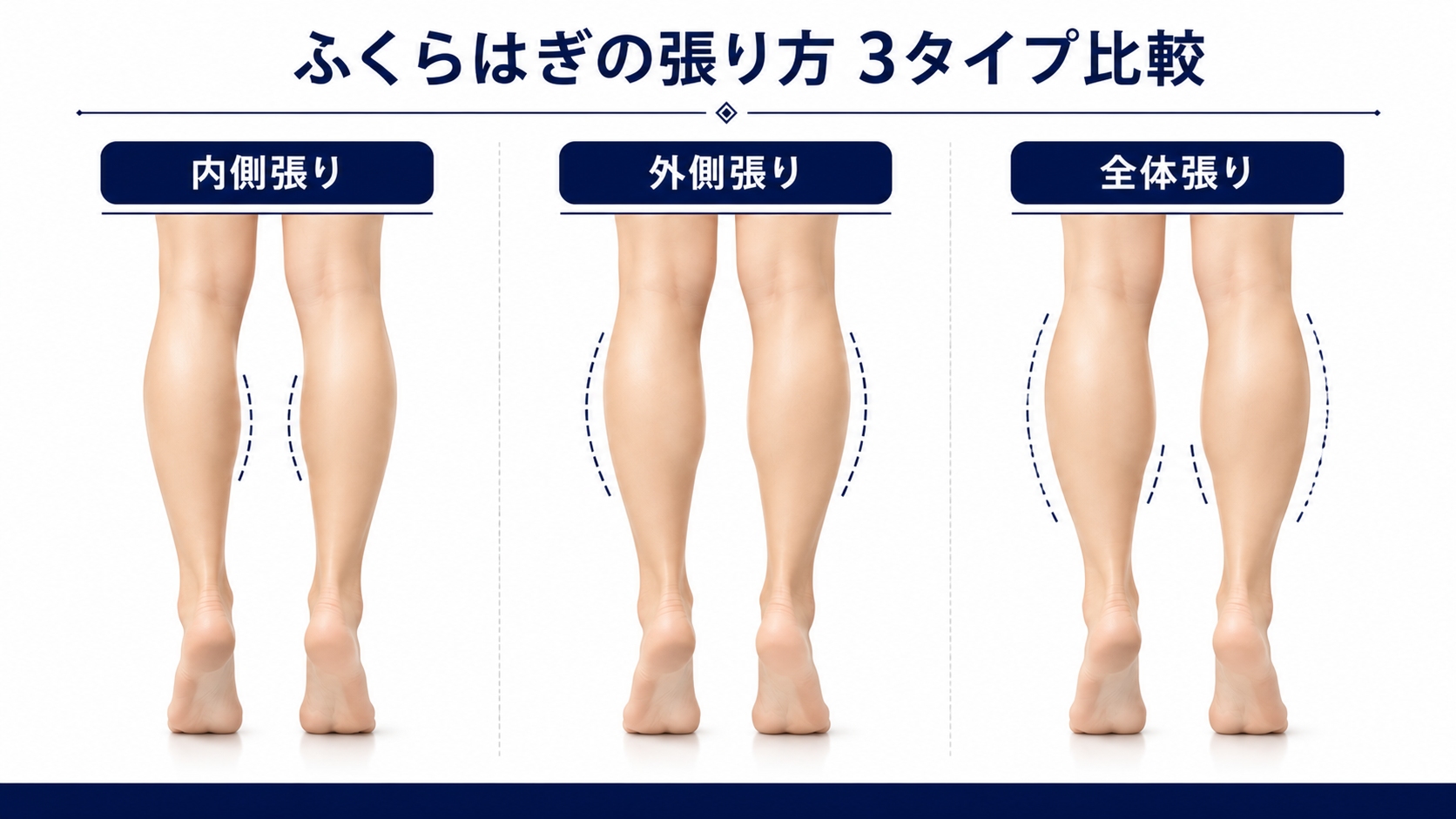 ふくらはぎの内側張り・外側張り・全体張りの違い