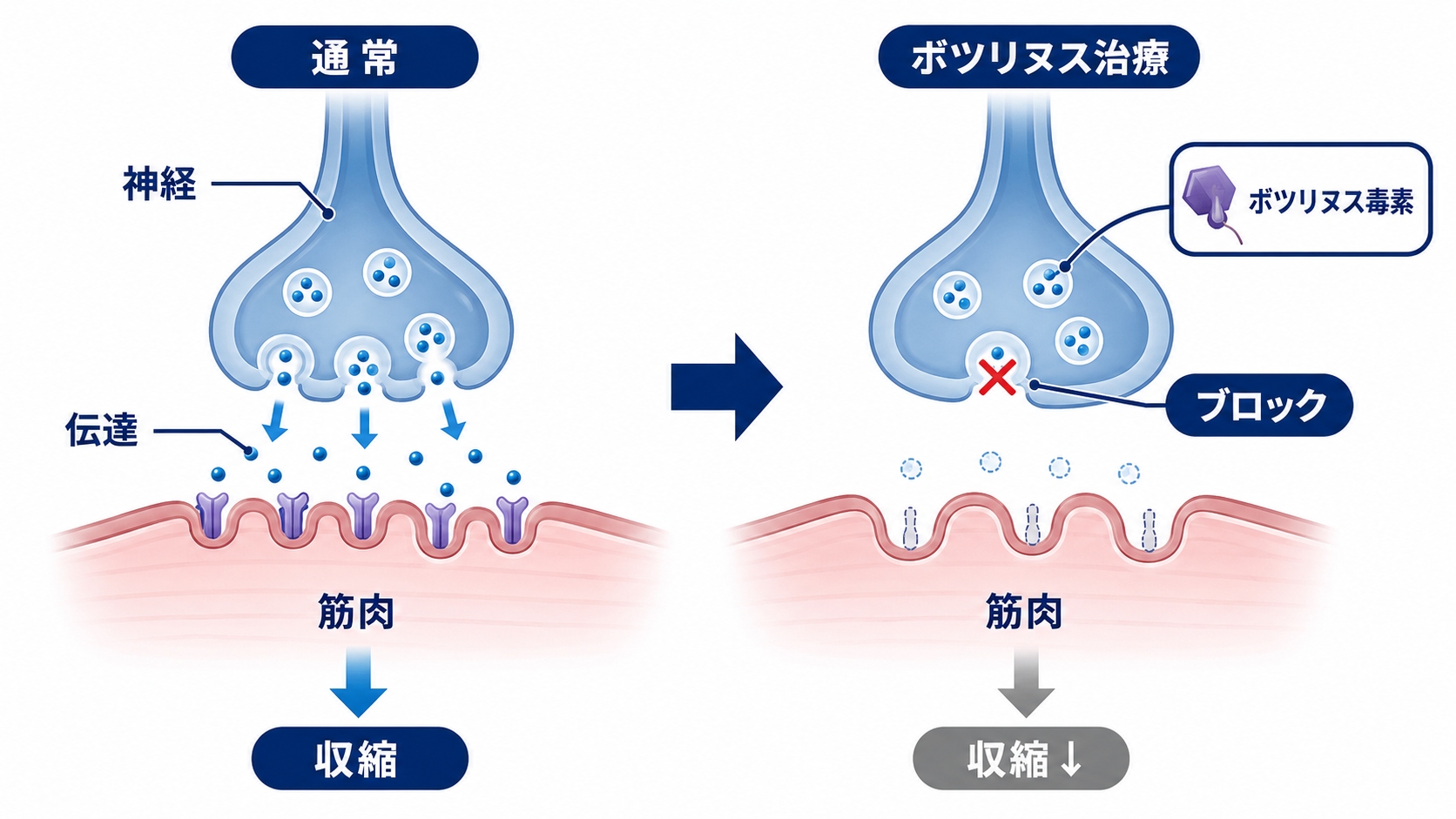 神経伝達物質のブロックを図解