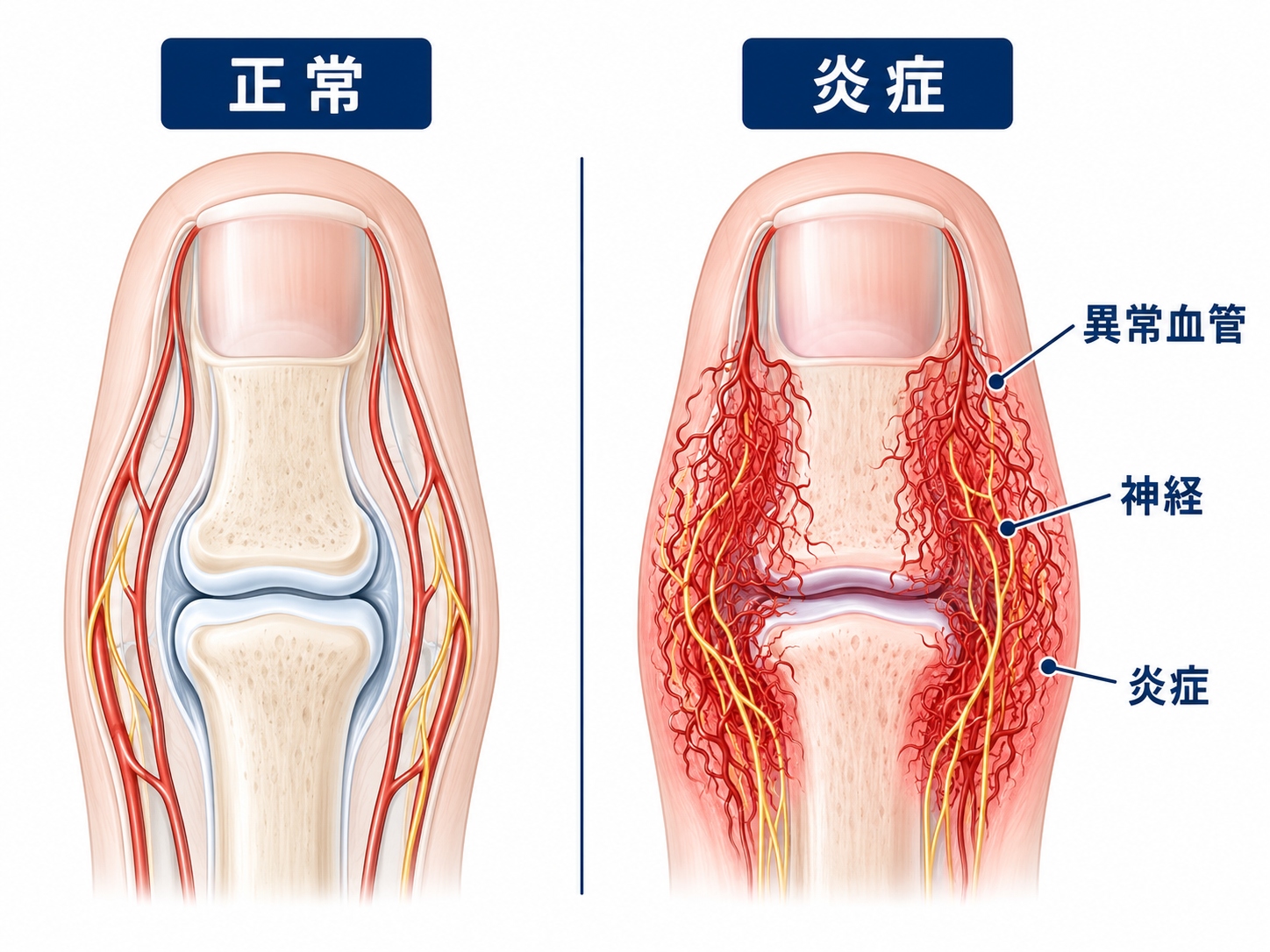指先の第一関節周辺に現れるもやもや血管の様子
