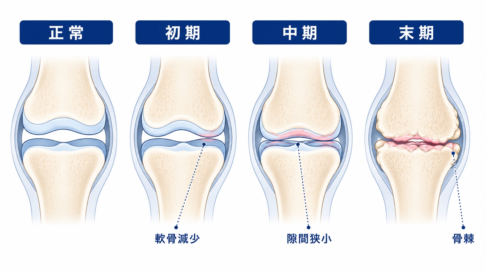 膝関節の構造と変形性膝関節症のメカニズム図解