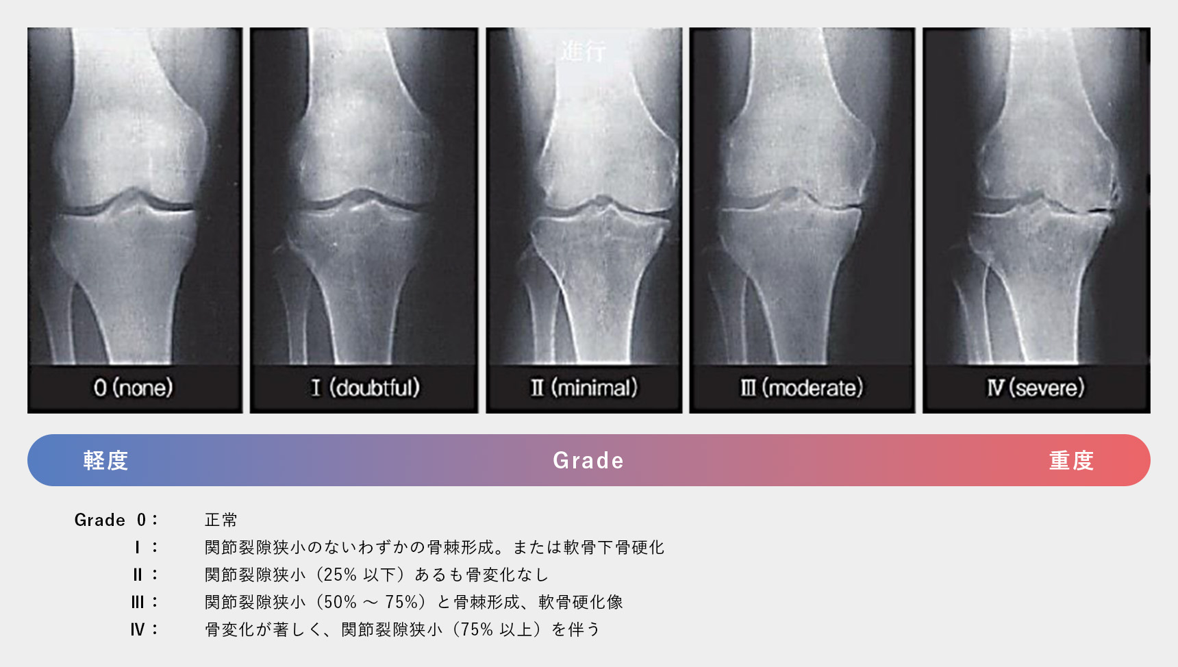 変形性膝関節症による軟骨のすり減りと痛みのイメージ