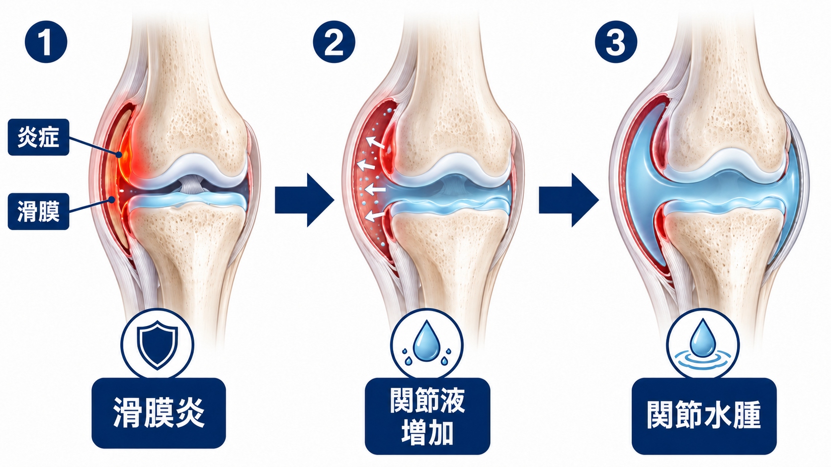 膝に水がたまる原因とメカニズム
