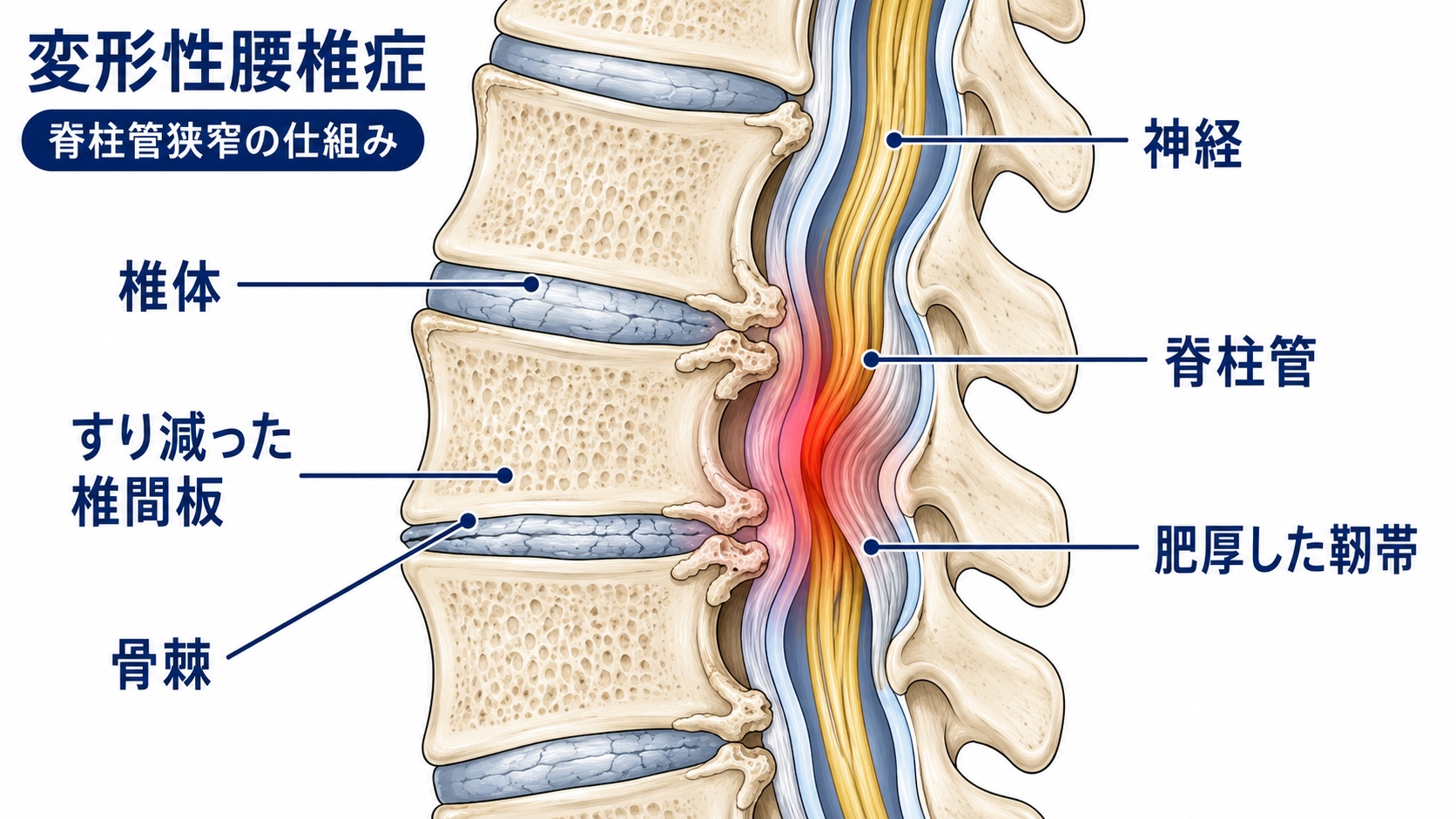 変形性腰椎症のメカニズム図解