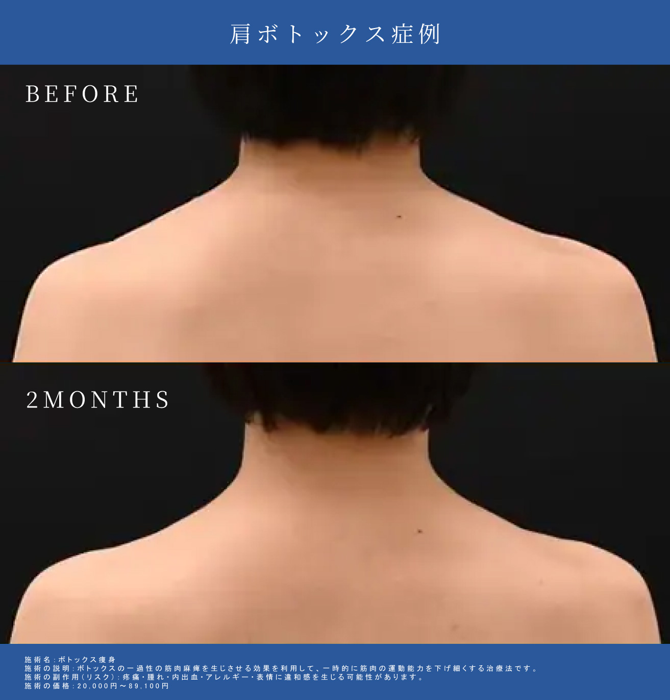 肩ボトックス施術前と2か月後