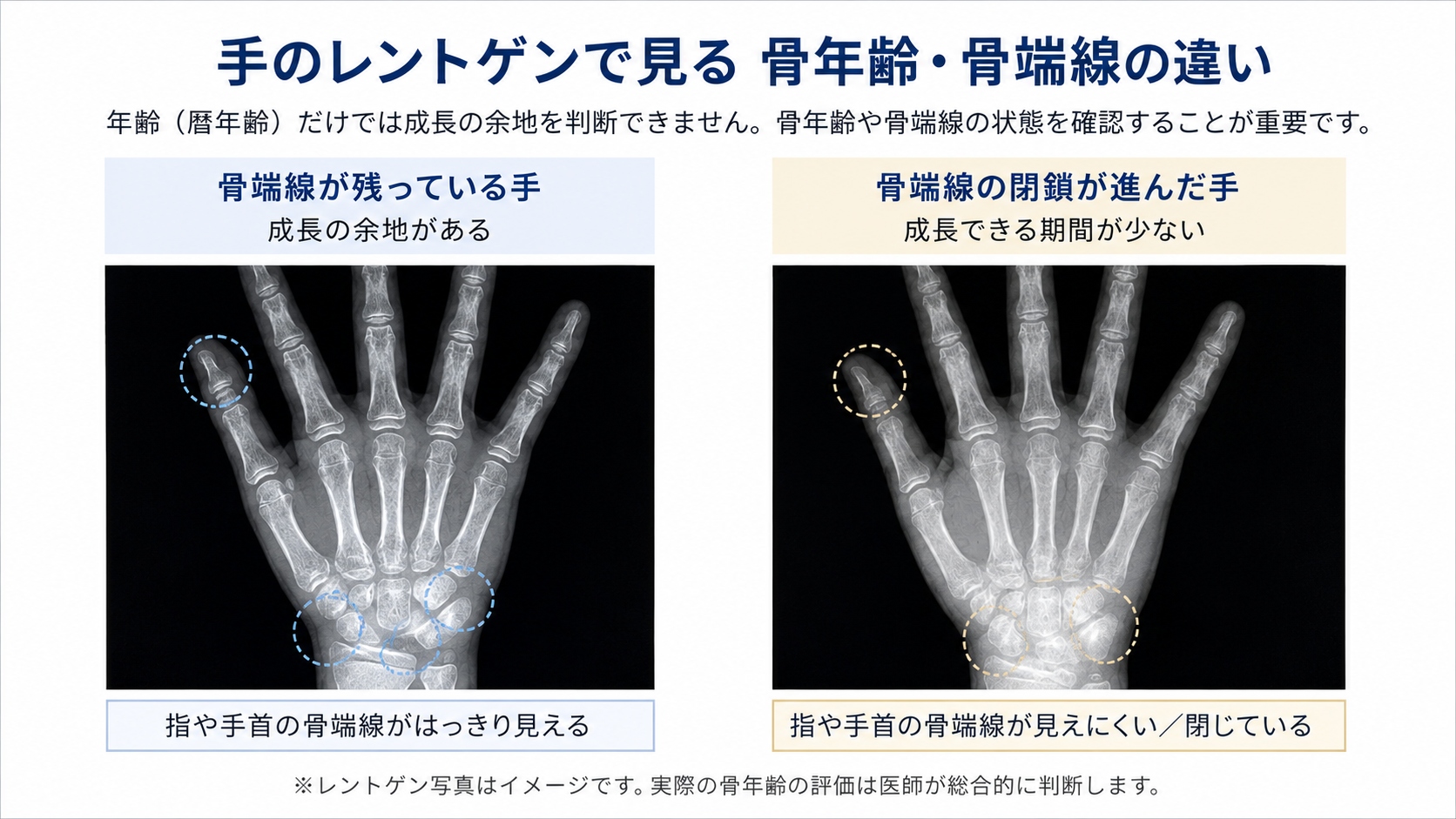 手のレントゲンで確認する骨年齢と骨端線の違い